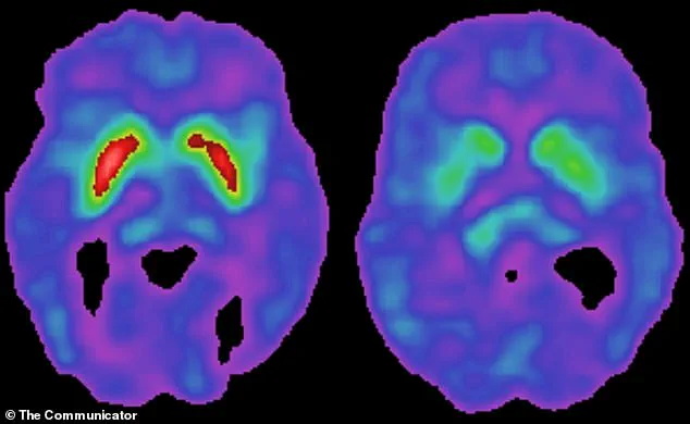 Scientists Discover Link Between Human Pegavirus and Parkinson’s Disease, Raising New Questions About the Neurological Disorder