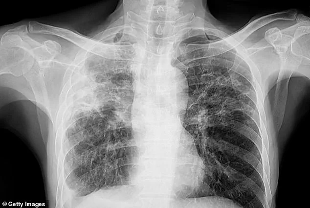 Urgent Alert: Three Separate Tuberculosis Cases in Maine's Greater Portland Area Prompt Health Officials to Act – WHO Highlights Disease's Deadliness