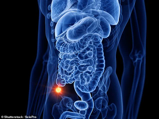 Appendix Cancer Cases Triple in Under-50s, Experts Sound Alarm Over Surge