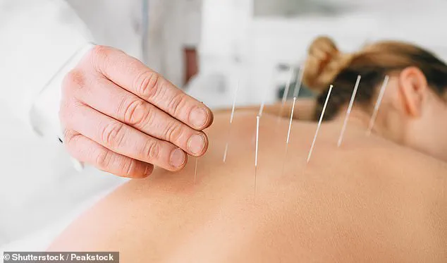 Breakthrough Study Reveals Acupuncture Offers Year-Long Relief for Chronic Lower Back Pain, Challenging Conventional Treatments