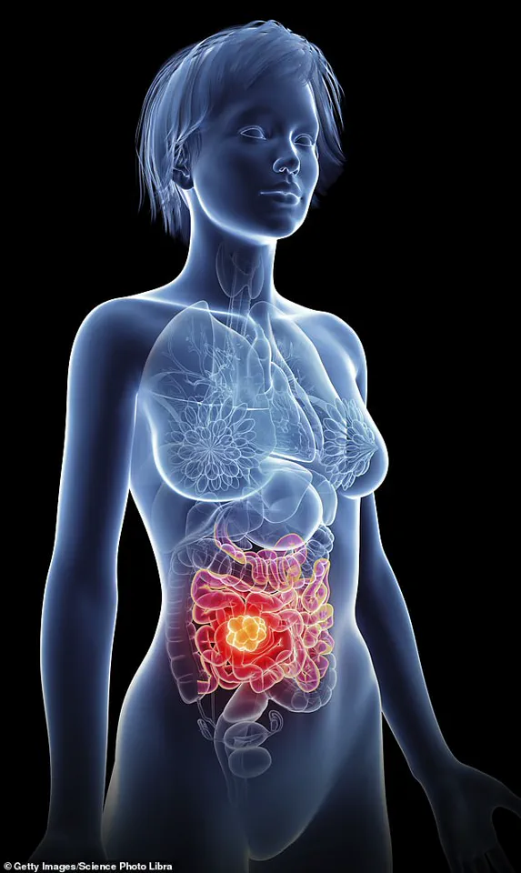 Surge in Bowel Cancer Among Young Adults Sparks Urgent Calls for Action