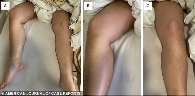 Rosuvastatin's Severe Adverse Reaction Raises Alarms for Community Health