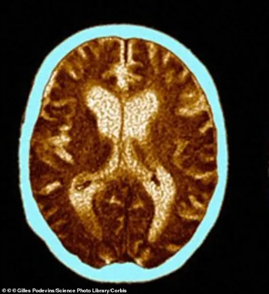 Urgent Warning: Visible Aging Signs Linked to 60% Higher Dementia Risk, Study Finds