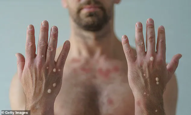 First Mpox Case in Alaska Since 2023 Confirmed; Health Officials Highlight Travel History and Public Health Measures