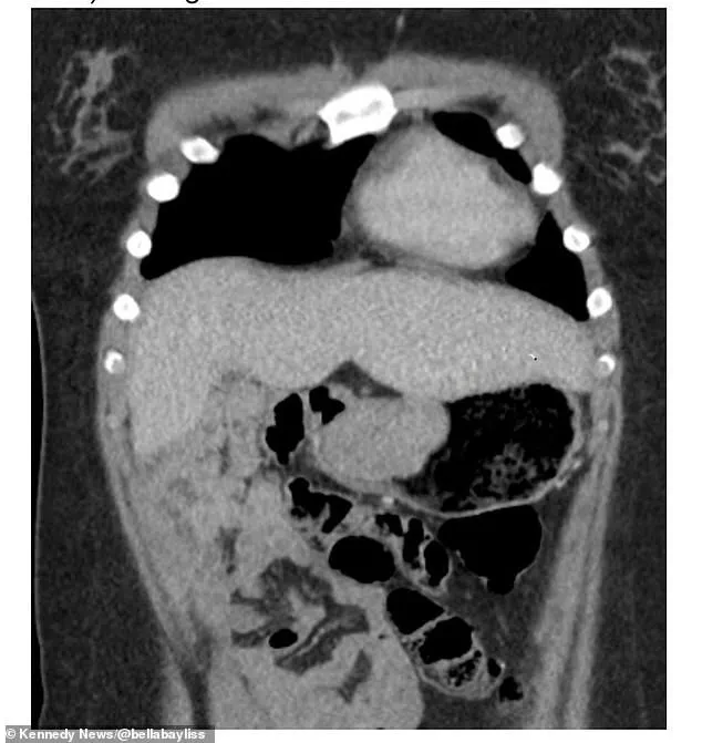 Ignored Symptoms and Limited Access: Bella Bayliss's Medical Crisis