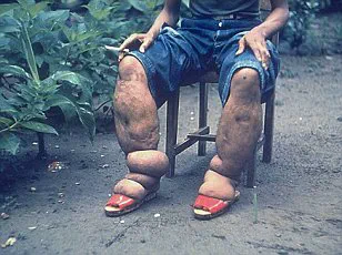 Surge in Parasite-Infected Kissing Bugs at US-Mexico Border Signals Rising Chagas Disease Risk