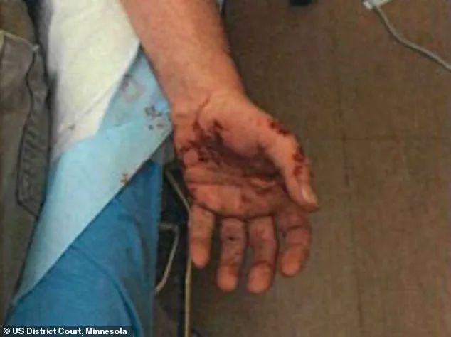 ICE Agent Jonathan Ross, Involved in Minneapolis Shooting, Shows Scars from Prior Dragging Incident in Court