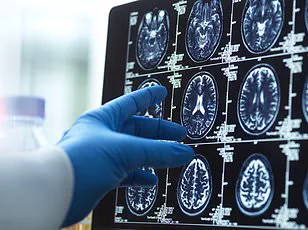 Medical Mystery: 19-Year-Old Boy Diagnosed with Alzheimer's, Challenging Scientific Understanding