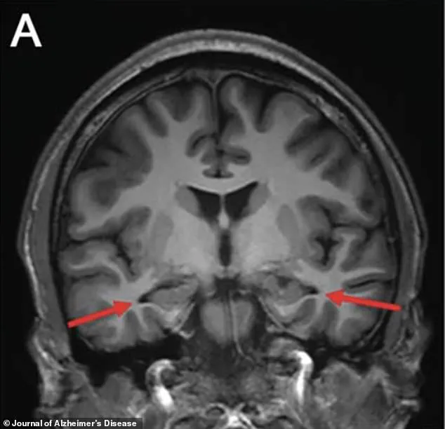 Medical Mystery: 19-Year-Old Boy Diagnosed with Alzheimer's, Challenging Scientific Understanding
