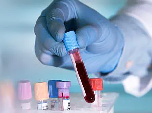 Breakthrough Discovery: Scientists Uncover Biological Link Between Gender and Multiple Myeloma Risk