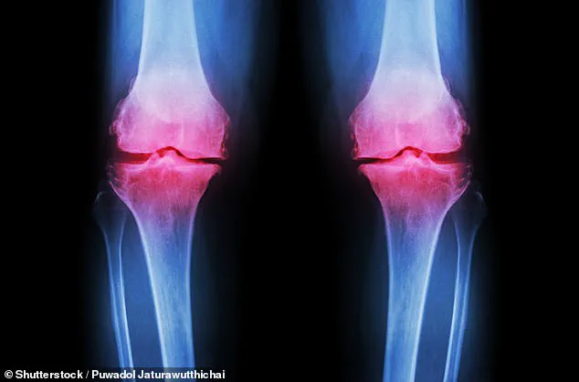 Stanford Scientists' Groundbreaking Discovery Offers New Hope for Arthritis Patients