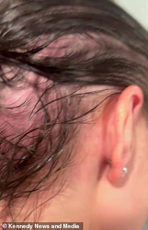 Colorado Student's Hair Loss Unveils Hidden Home Hazard and Health Crisis