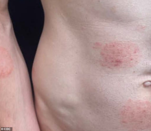 Minnesota Faces Largest Ringworm Outbreak in U.S. History, Linked to Rare Fungal Strain TMVII and Shared Personal Items