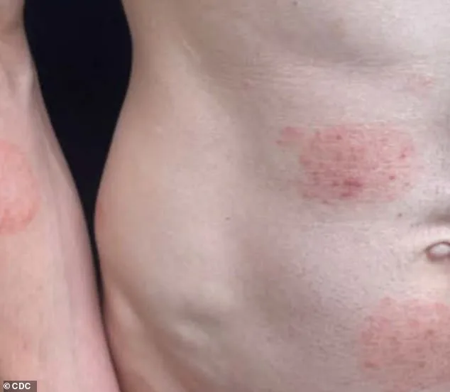 Minnesota Faces Largest Ringworm Outbreak in U.S. History, Linked to Rare Fungal Strain TMVII and Shared Personal Items