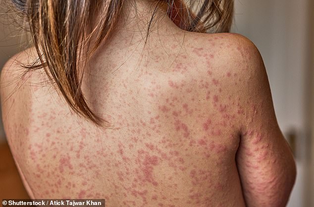 London on Brink of Measles Outbreak as Cases Surge Among Children