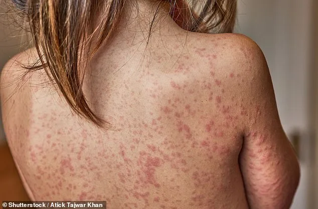 London on Brink of Measles Outbreak as Cases Surge Among Children