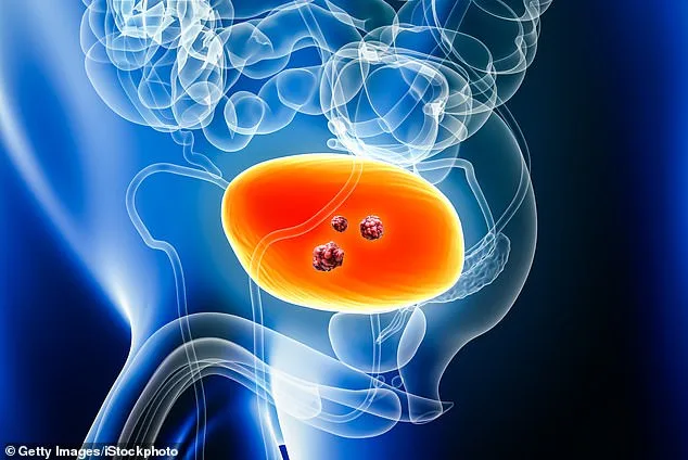 NHS Approves Durvalumab, Offering New Hope for Muscle-Invasive Bladder Cancer Patients