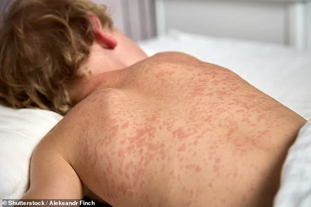 Measles Exposure at Philadelphia Airport: Thousands Exposed Amid Historic Outbreak