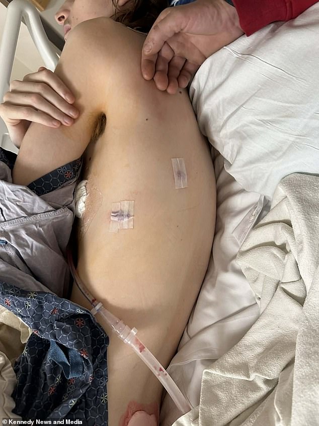 Mother's Heartbreak as Son's Vaping Leads to Life-Threatening Lung Collapse