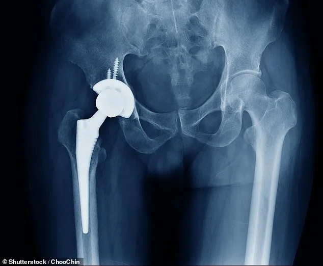 NHS Faces Crisis as Bone Cement Shortage Threatens to Cancel Nearly a Million Surgeries