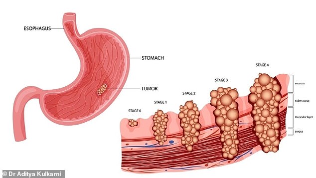 Stomach Cancer Makes a Deadly Comeback: Rising Cases and Overlooked Symptoms Alarm Doctors
