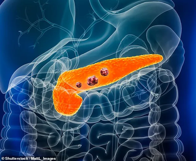 Groundbreaking Study Unveils Early Warning Signal for Pancreatic Cancer: Pre-Cancerous Clusters Signal Immune Evasion