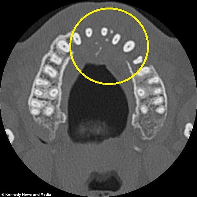 Tooth Pain as a Warning Sign: Man's Aggressive Cancer Diagnosis Highlights Importance of Early Dental Care