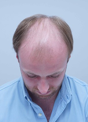 From Self-Consciousness to a Full Head of Hair: Alex Aitken's Journey to Confidence