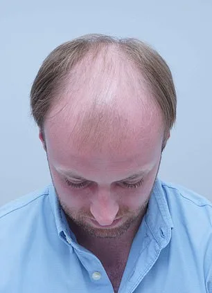 From Self-Consciousness to a Full Head of Hair: Alex Aitken's Journey to Confidence