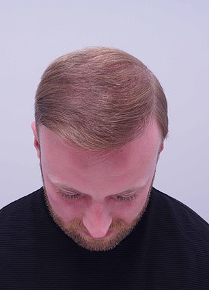 From Self-Consciousness to a Full Head of Hair: Alex Aitken's Journey to Confidence