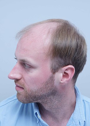 From Self-Consciousness to a Full Head of Hair: Alex Aitken's Journey to Confidence