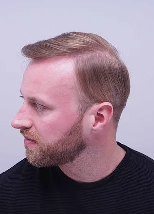 From Self-Consciousness to a Full Head of Hair: Alex Aitken's Journey to Confidence