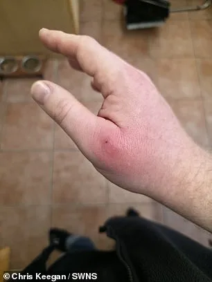 Coventry Man's Spider Bite Nearly Costs Him His Hand as UK Warns of Growing False Widow Threat