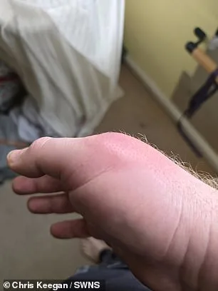 Coventry Man's Spider Bite Nearly Costs Him His Hand as UK Warns of Growing False Widow Threat