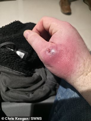 Coventry Man's Spider Bite Nearly Costs Him His Hand as UK Warns of Growing False Widow Threat