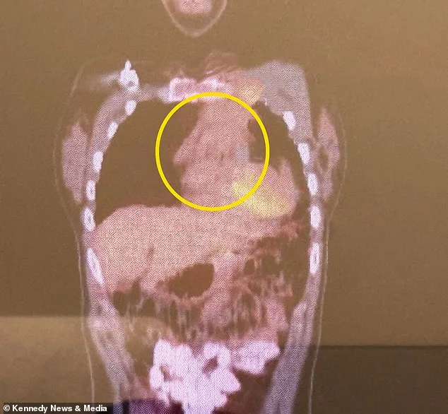 From Hives to Health Crisis: A College Student's Battle with Unexplained Symptoms