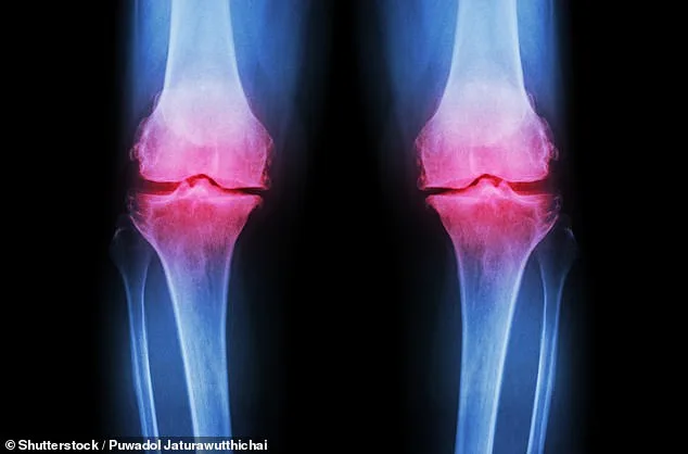 University of Nottingham Study Finds Low-Cost Inulin Supplement May Ease Osteoarthritis Pain
