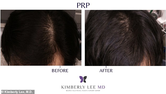Battling Hair Loss Fears: Rising PRP Therapy Offers New Hope
