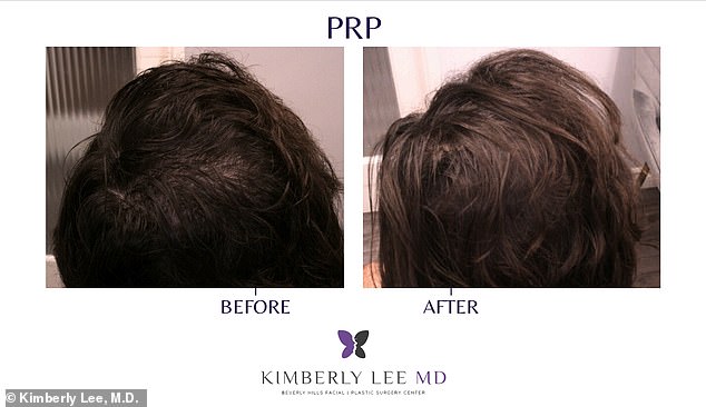 Battling Hair Loss Fears: Rising PRP Therapy Offers New Hope