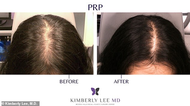 Battling Hair Loss Fears: Rising PRP Therapy Offers New Hope