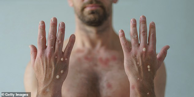 New York Confirms First Local Clade I Mpox Case in U.S.; Public Risk Remains Low