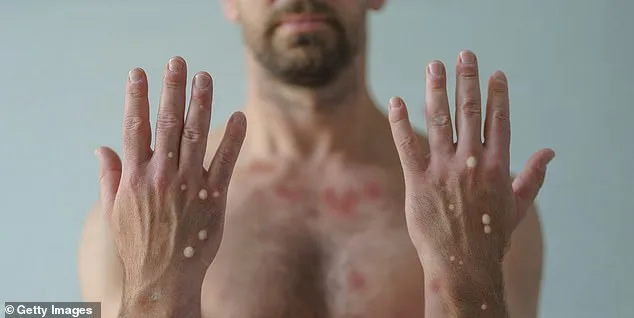 New York Confirms First Local Clade I Mpox Case in U.S.; Public Risk Remains Low