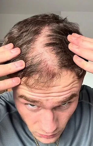 Baldness and Confidence: A Young Man's Battle with Hair Loss and the Tools He Used to Hide It