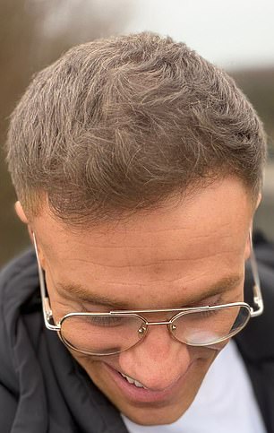 Baldness and Confidence: A Young Man's Battle with Hair Loss and the Tools He Used to Hide It