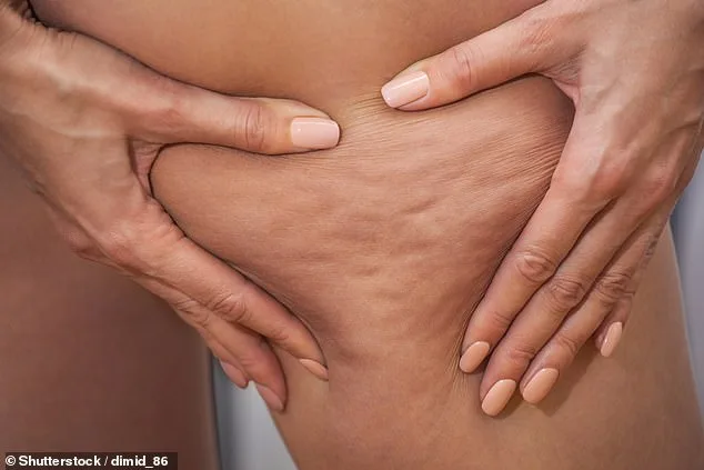 From Diet to Disease: How Doja Cat and Celebs Are Raising Awareness About Lipoedema