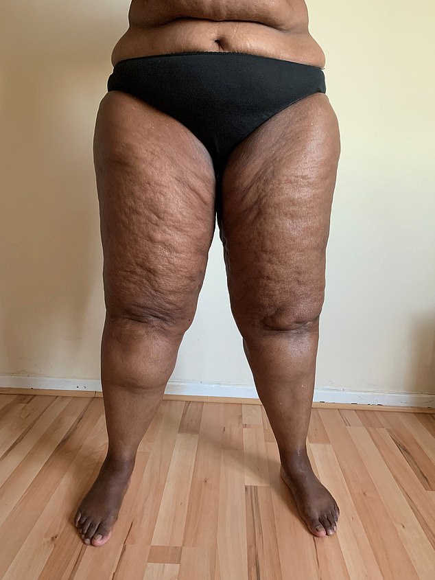 From Diet to Disease: How Doja Cat and Celebs Are Raising Awareness About Lipoedema