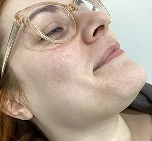 Hirsutism and PCOS: A Birmingham Woman's Relentless Daily Battle