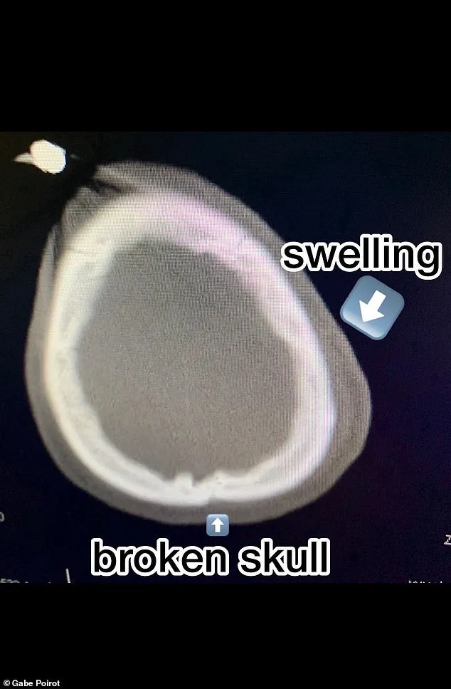 Miraculous Recovery: Gabriel Poirot Survives Fatal Skateboard Crash and Brain Injury Against Doctors' Odds