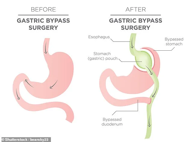 Surge in NHS Bariatric Surgeries Sparks Nationwide Conversation on Obesity Treatment in England