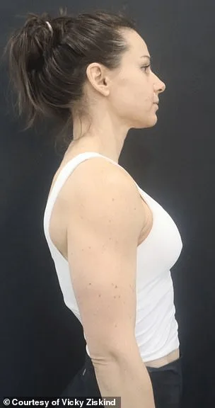 Innovative 'Cake Frosting Bag' Technique Redefines Breast Enlargement Surgery with Dr. Smita Ramanadham